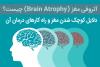 آتروفی مغز
