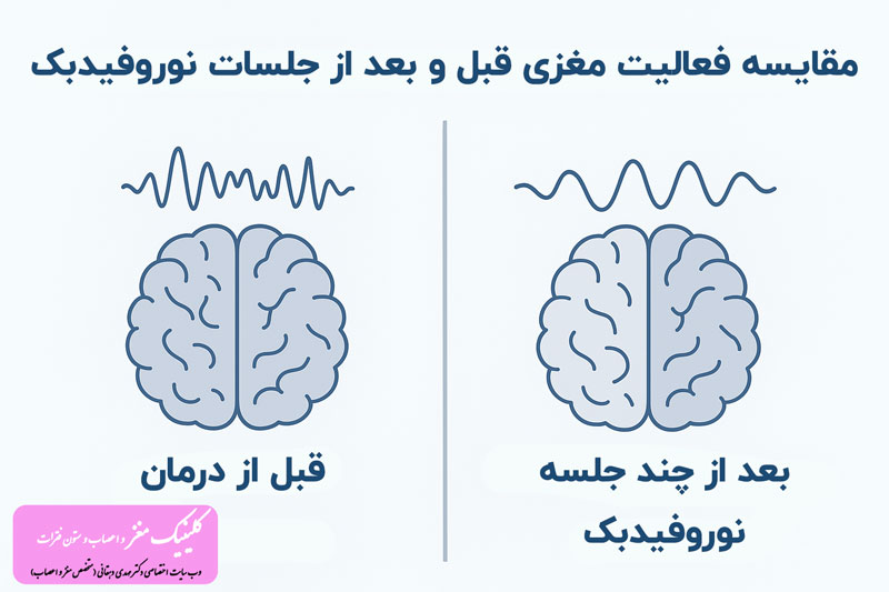 مقایسه فعالیت مغزی قبل و بعد از جلسات نوروفیدبک مقایسه فعالیت مغزی قبل و بعد از جلسات نوروفیدبک