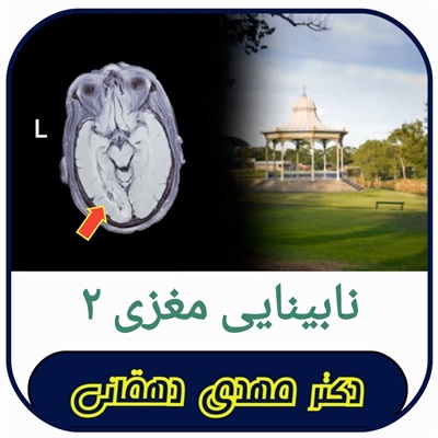 🔴 نابینایی مغزی!
