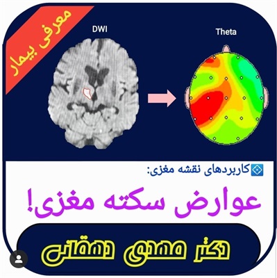 🔴 عوارض سکته مغزی!