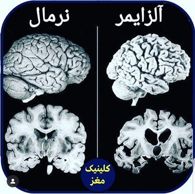 🔴 مغز در آلزایمر!